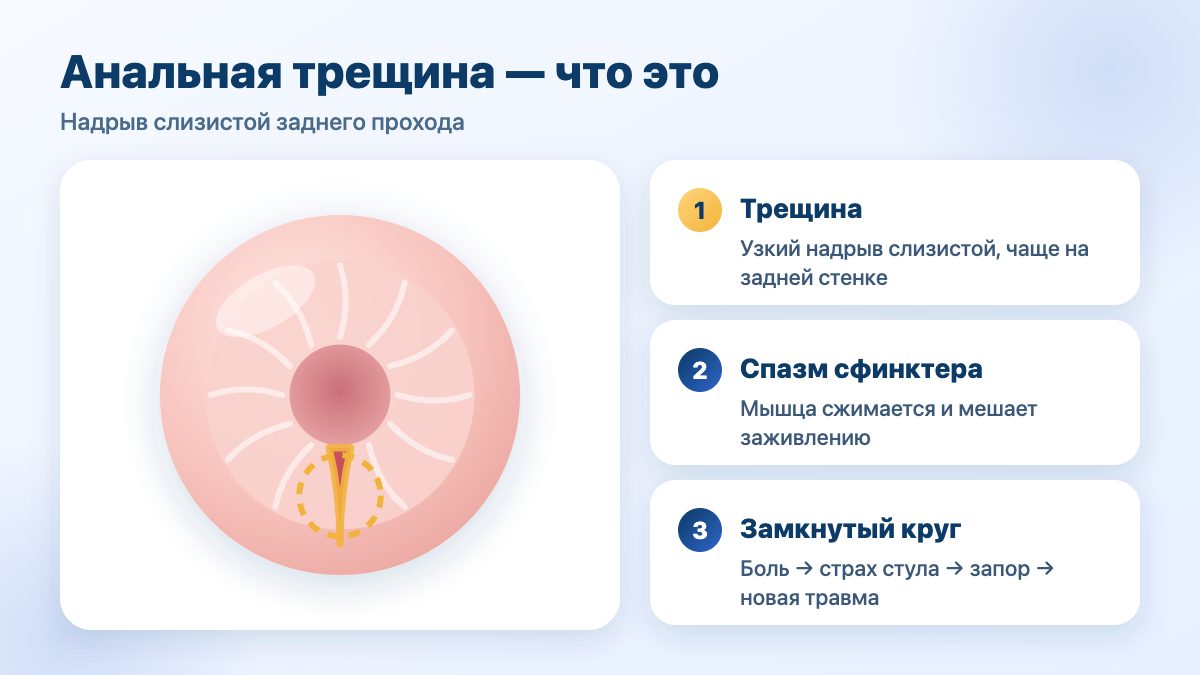 Анальная трещина: надрыв слизистой заднего прохода и спазм сфинктера — схема