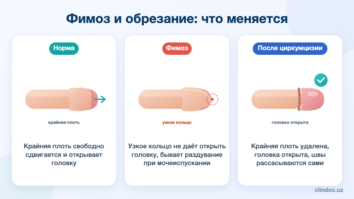 Фимоз и обрезание: норма, сужение крайней плоти и результат циркумцизии — схема
