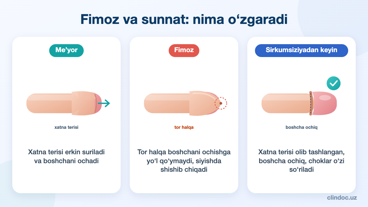 Fimoz va sunnat: me’yor, xatna terisining torayishi va sirkumsiziya natijasi — sxema
