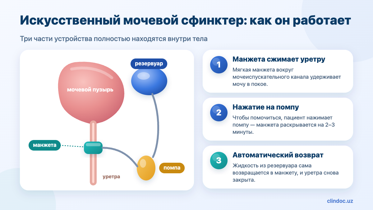 Имплантация искусственного мочевого сфинктера — схема устройства: манжета, резервуар, помпа