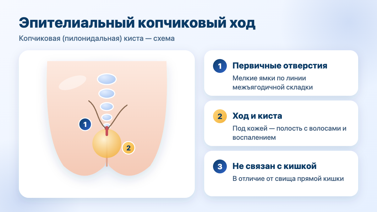 Эпителиальный копчиковый ход (копчиковая, пилонидальная киста): первичные отверстия и киста под кожей — схема