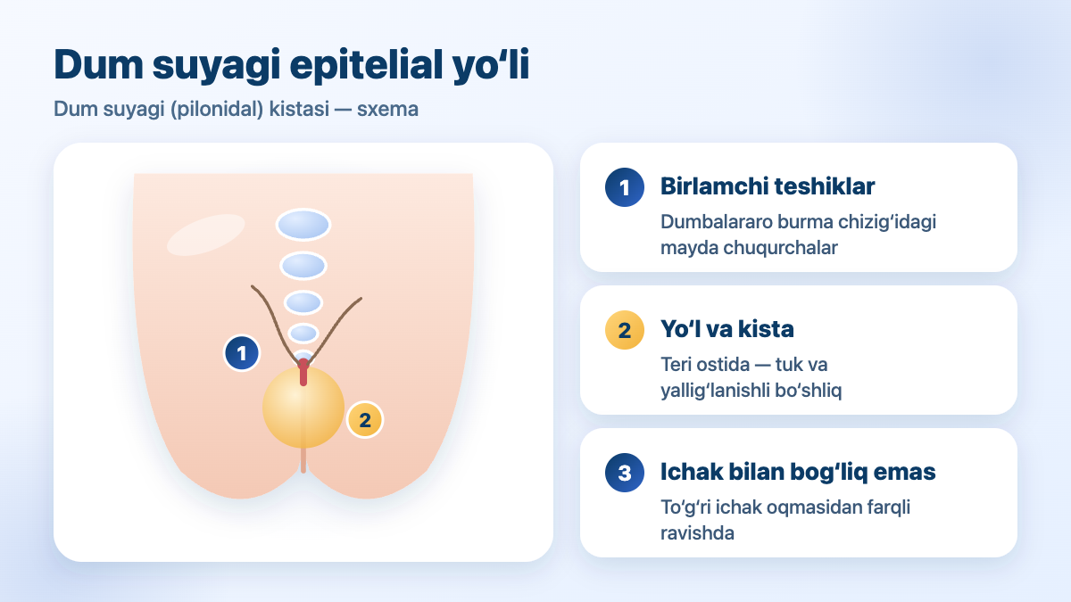 Dum suyagi epitelial yo‘li (dum suyagi, pilonidal kistasi): birlamchi teshiklar va teri ostidagi kista — sxema