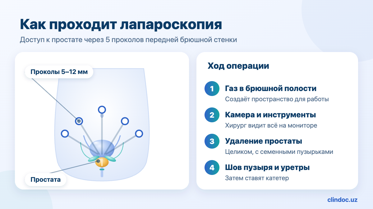 Лапароскопическая простатэктомия — проколы и доступ к простате, схема