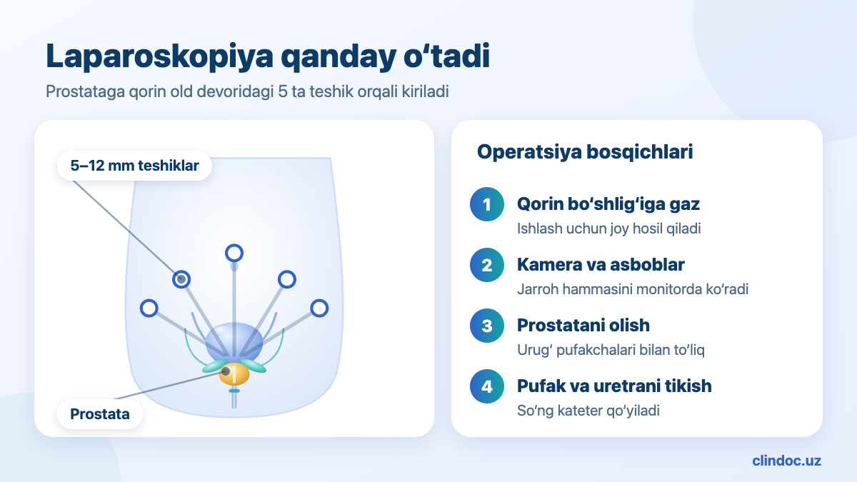 Laparoskopik prostatektomiya — teshiklar va prostataga kirish yo‘li, sxema