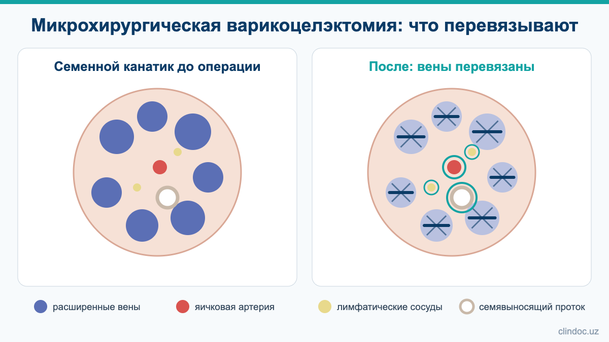 Микрохирургическая варикоцелэктомия: расширенные вены перевязаны, артерия, лимфатические сосуды и семявыносящий проток сохранены