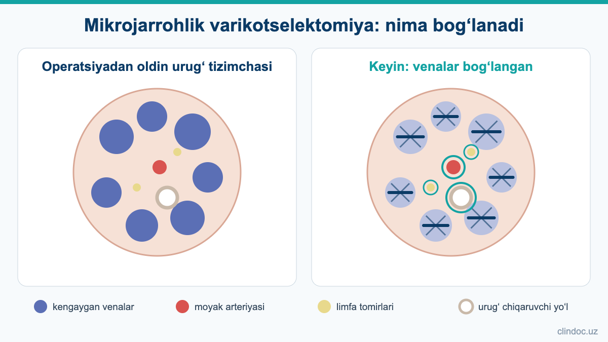 Mikrojarrohlik varikotselektomiya: kengaygan venalar bog‘langan, arteriya, limfa tomirlari va urug‘ chiqaruvchi yo‘l saqlangan