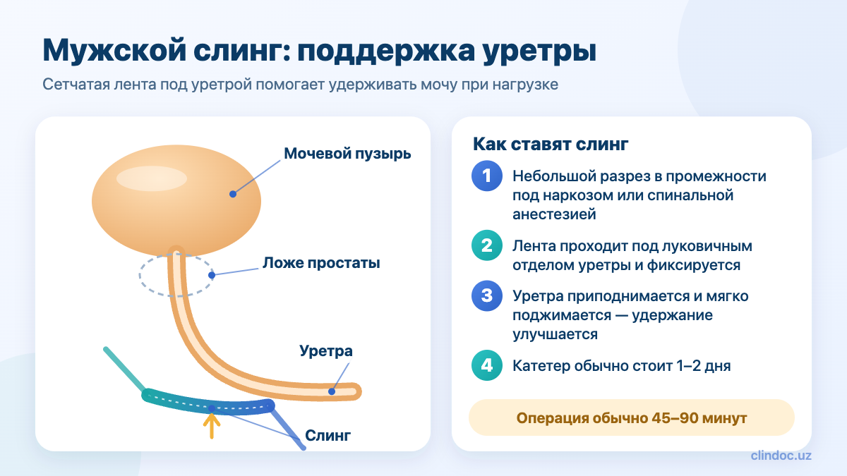Установка мужского слинга при недержании мочи — схема операции