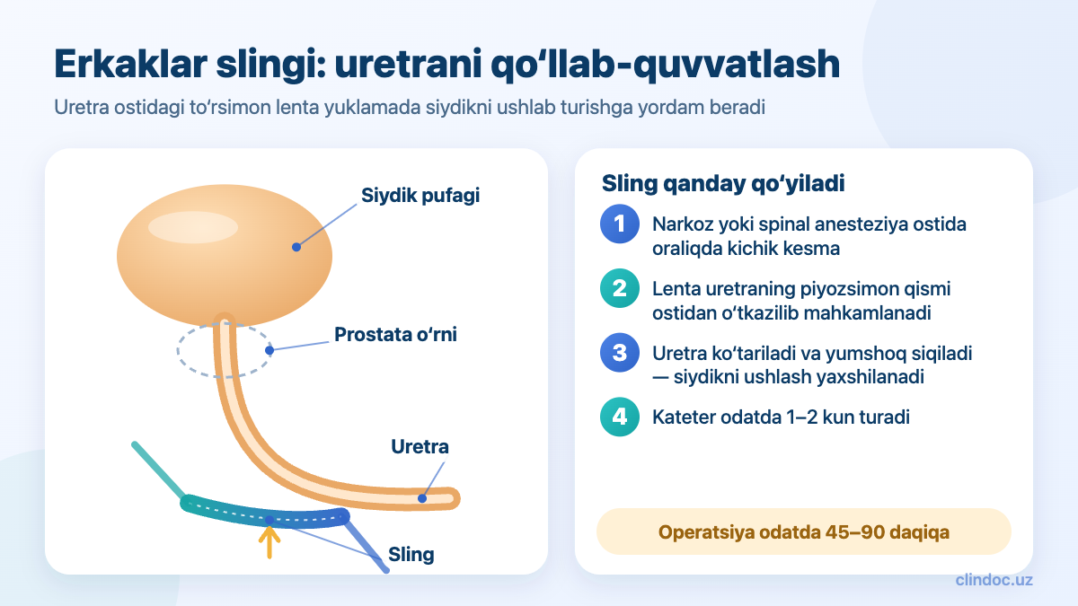 Erkaklarda siydik ushlab tura olmaslikda sling o‘rnatish — operatsiya sxemasi