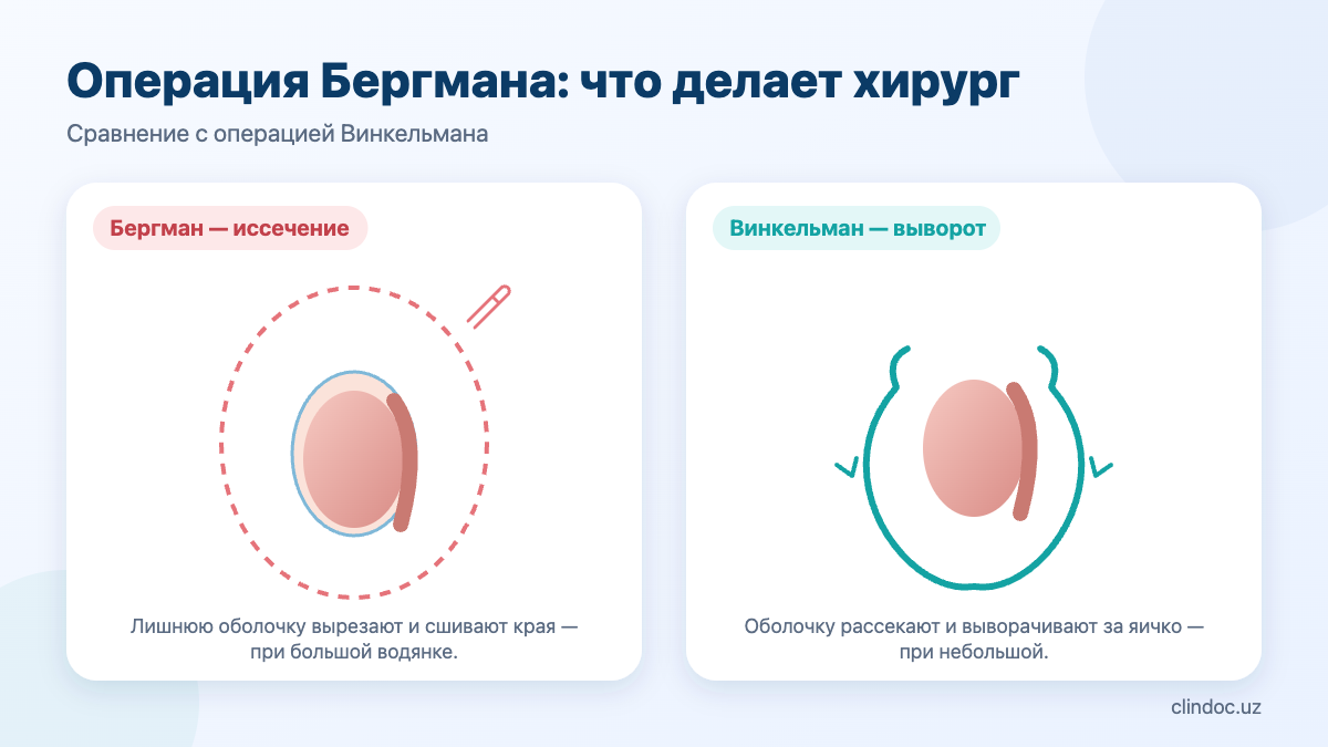 Операция Бергмана при гидроцеле: иссечение оболочки яичка в сравнении с операцией Винкельмана — схема