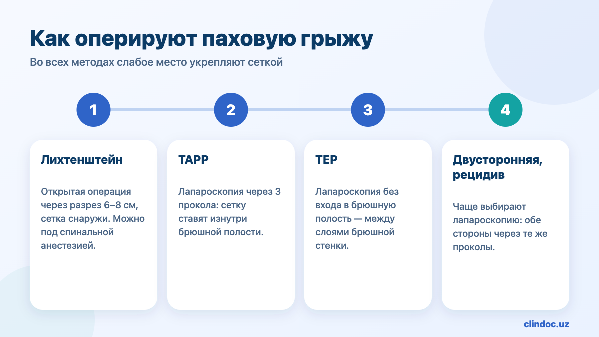 Как оперируют паховую грыжу: операция Лихтенштейна, лапароскопическая герниопластика TAPP и TEP
