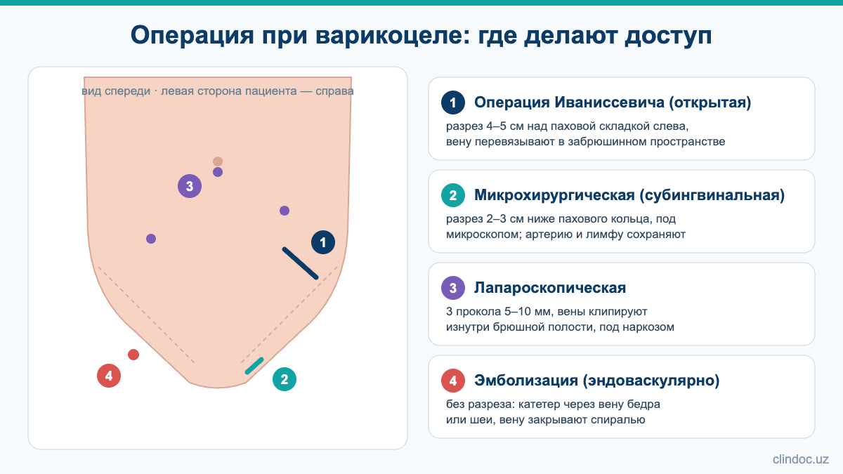 Операция при варикоцеле: доступ при операции Иваниссевича, микрохирургической, лапароскопической и эмболизации