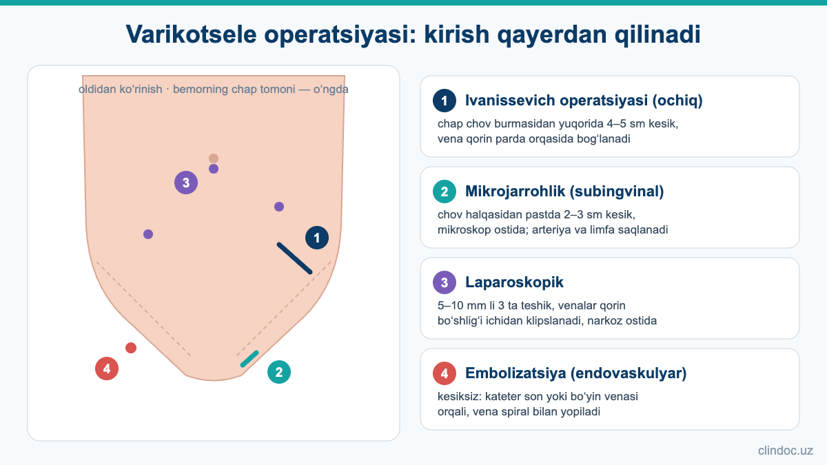 Varikotsele operatsiyasi: Ivanissevich, mikrojarrohlik, laparoskopik operatsiya va embolizatsiyada kirish joyi