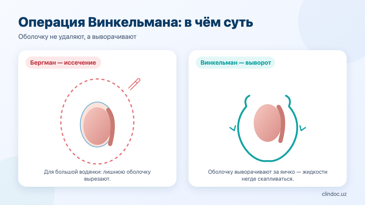 Операция Винкельмана при гидроцеле: выворот оболочки яичка в сравнении с операцией Бергмана — схема