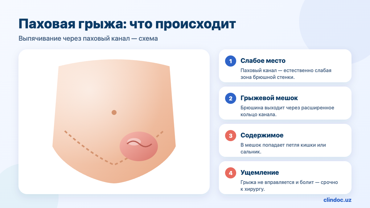 Паховая грыжа: выпячивание брюшины с кишкой через паховый канал — схема