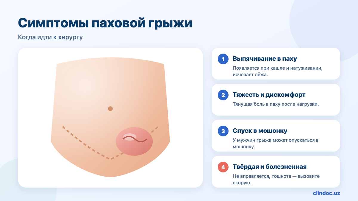 Симптомы паховой грыжи: выпячивание в паху, тяжесть, спуск в мошонку, ущемление