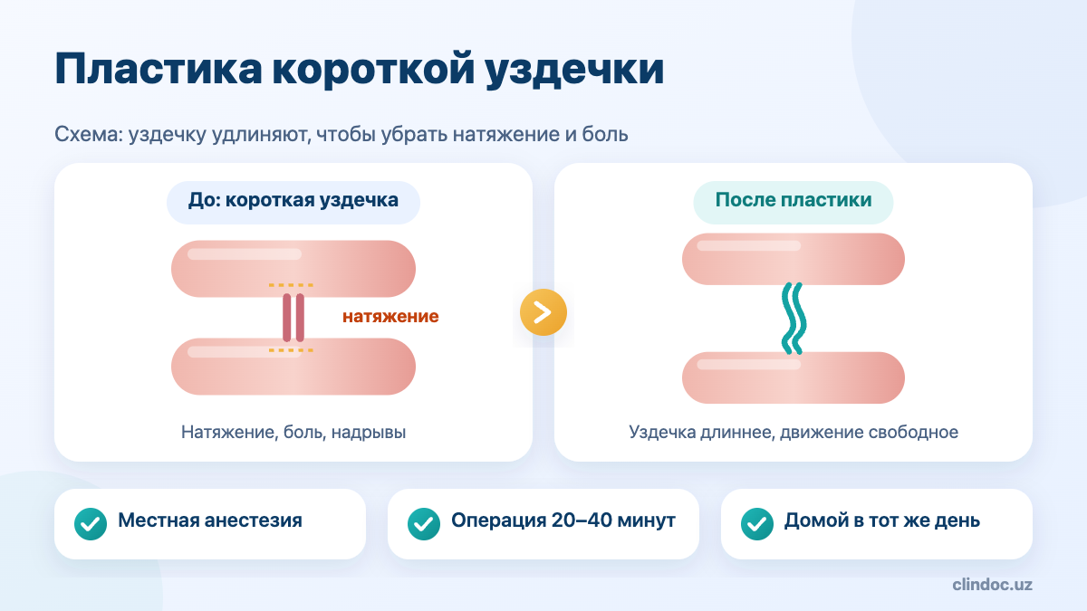Пластика короткой уздечки полового члена: схема до и после френулопластики
