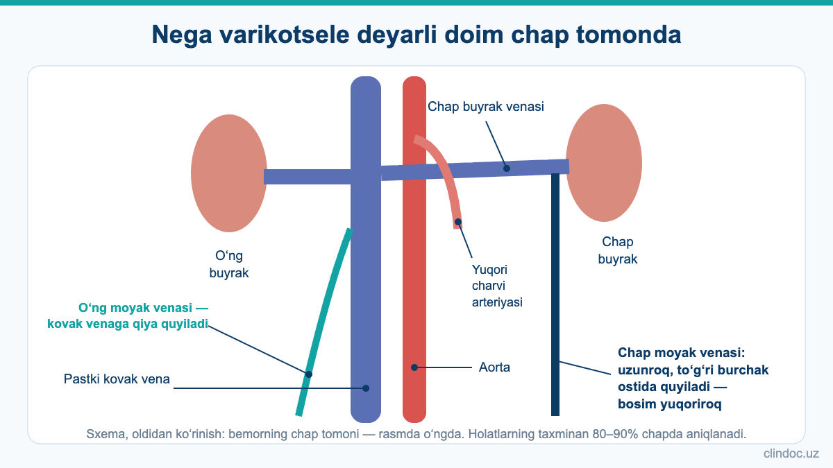 Nega varikotsele ko‘proq chapda: chap moyak venasi buyrak venasiga to‘g‘ri burchak ostida quyiladi