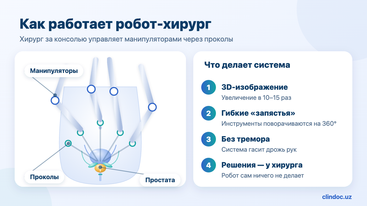 Робот-ассистированная простатэктомия — манипуляторы робота и проколы, схема