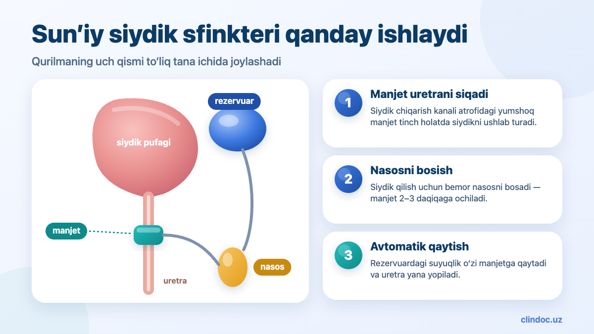 Sun’iy siydik sfinkteri implantatsiyasi — qurilma sxemasi: manjet, rezervuar, nasos