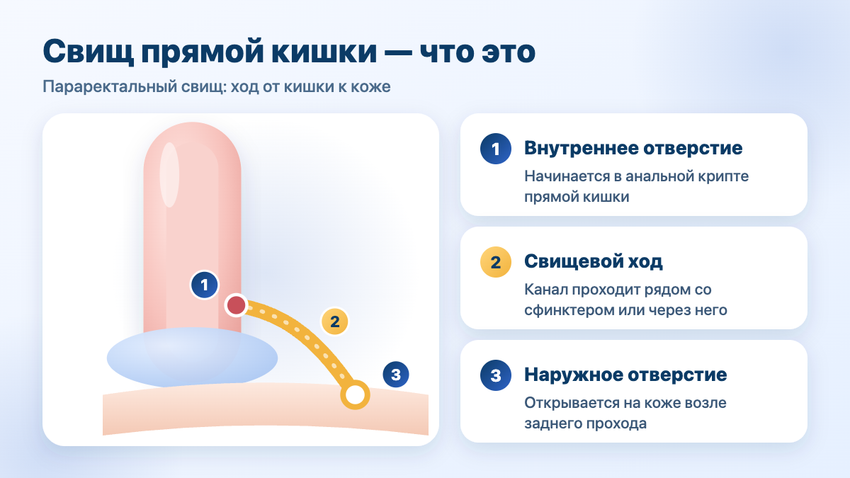 Свищ прямой кишки (параректальный свищ): внутреннее отверстие, свищевой ход, наружное отверстие — схема