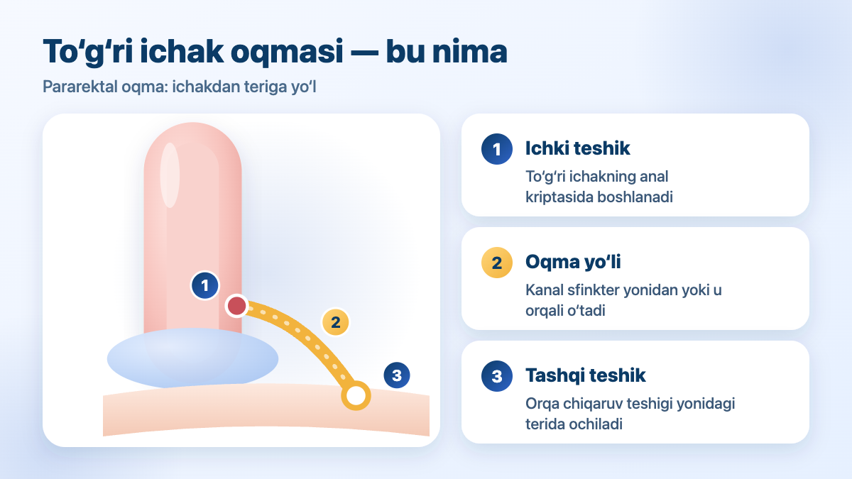 To‘g‘ri ichak oqmasi (pararektal oqma): ichki teshik, oqma yo‘li, tashqi teshik — sxema