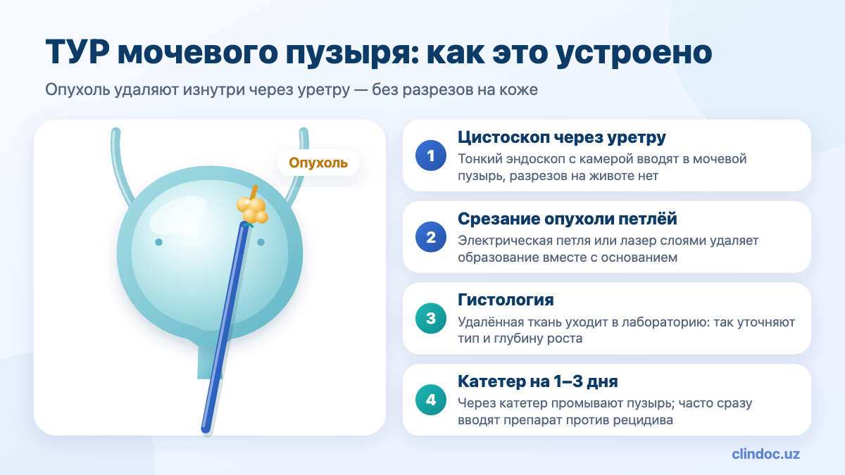 ТУР мочевого пузыря при опухоли — схема операции