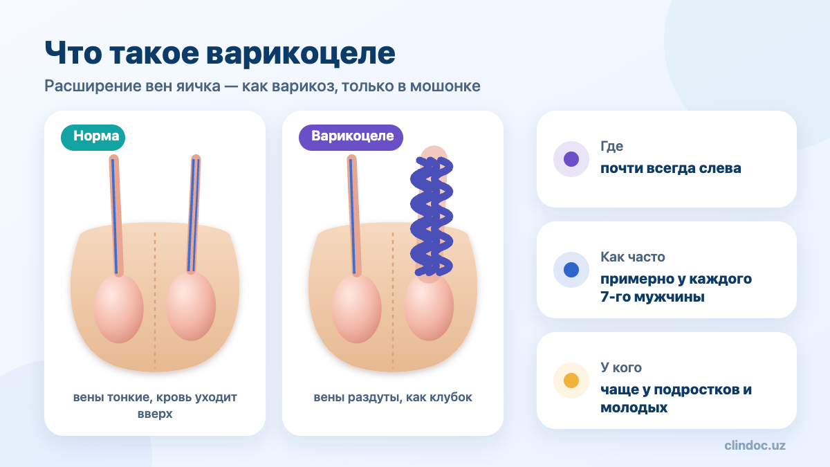 Что такое варикоцеле — норма и расширенные вены яичка