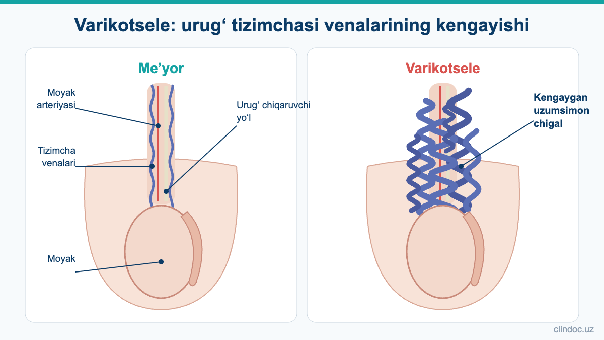 Varikotsele: urug‘ tizimchasining me’yoriy venalari va kengaygan uzumsimon chigal — sxema
