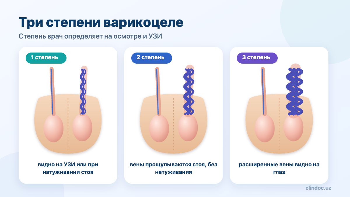 Три степени варикоцеле