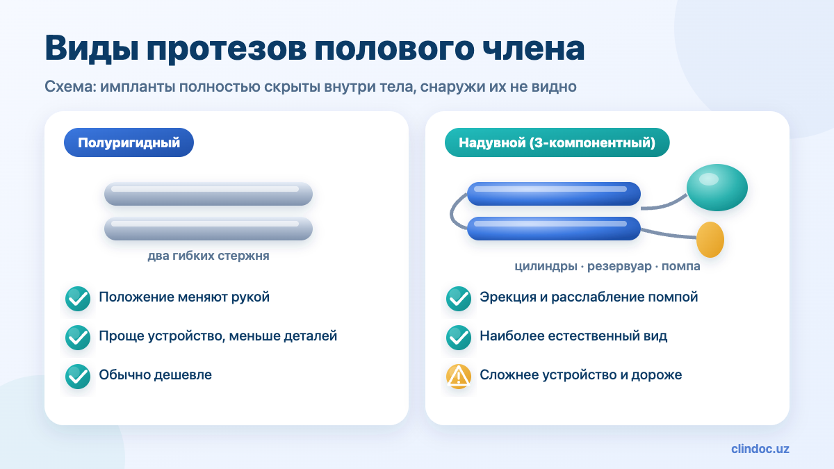 Имплантация протеза полового члена — виды протезов: полуригидный и надувной, схема